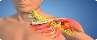 Brachial Plexus Surgery