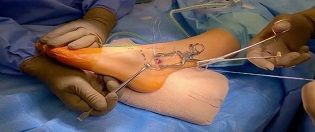 Foot Ankle Surgery
